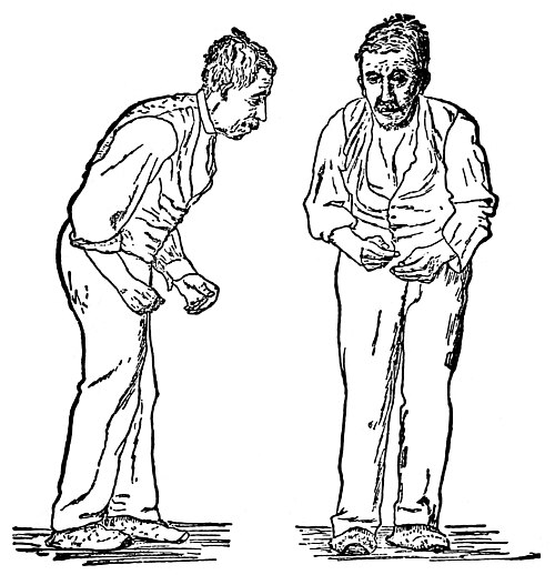 Parkinson kasalligi