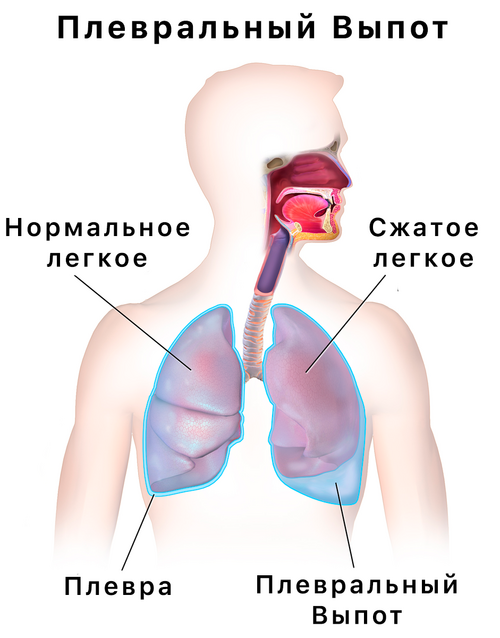 Plevra oqishi